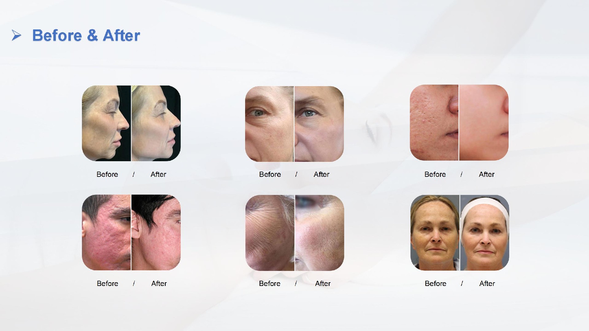 铒激光 Erbium laser Beijing Sanhe - 副本_10.jpg